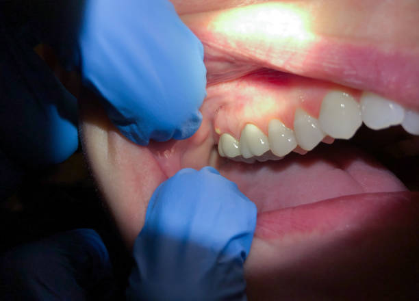 Best Emergency Gum Treatment in West Blocton, AL