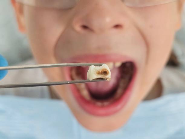 Best Emergency Treatment for Dental Infections or Abscesses in West Blocton, AL