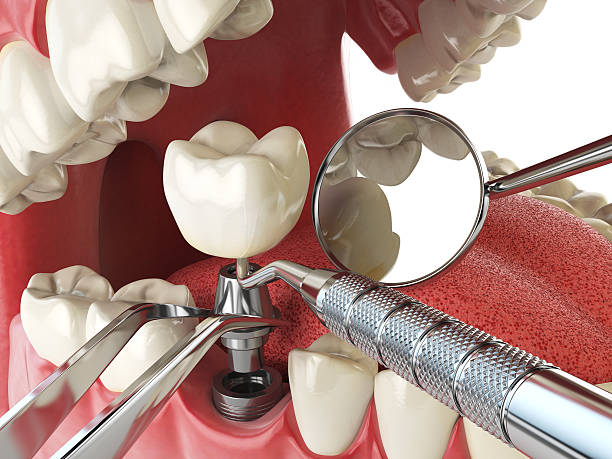 Best Emergency Treatment for Dental Infections or Abscesses in West Blocton, AL